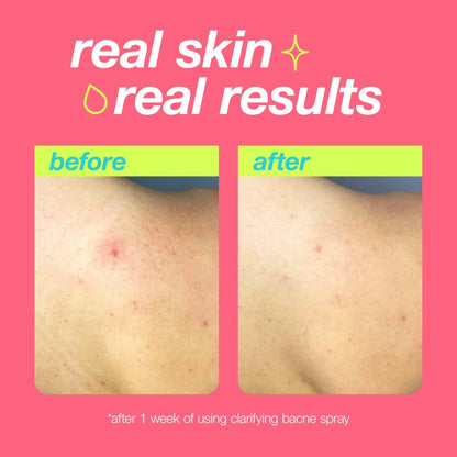 clarifying bacne spray